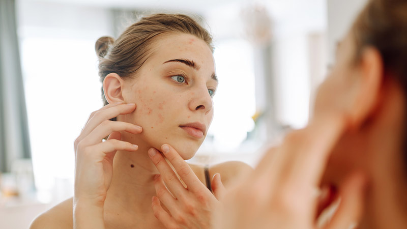 Les patchs pour l'acné sont-ils utiles?